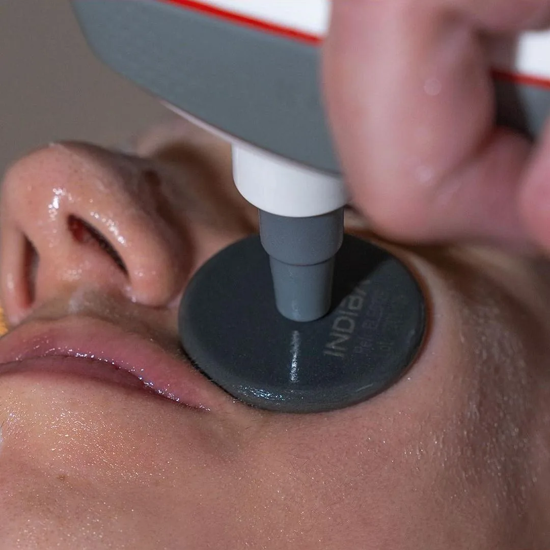 Detalle del cabezal de radiofrecuencia Indiba durante un tratamiento facial en Irún